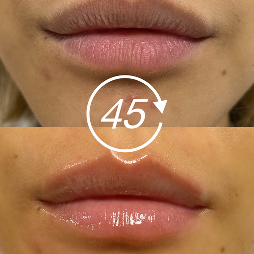 Маска LusciousLips для губ Lip Infusion Therapy восстанавливающая LIT 4 шт